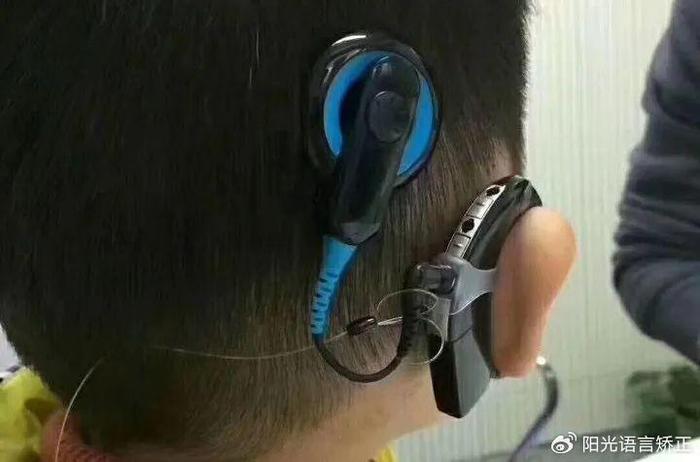 美国人工耳蜗最新款,重塑听力的革命性技术突破