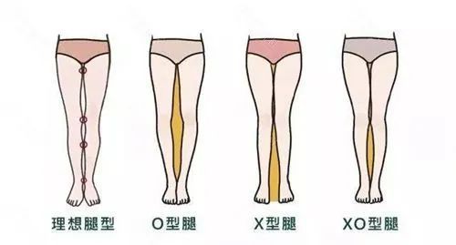 揭秘O型腿手术价格,让你摆脱烦恼!